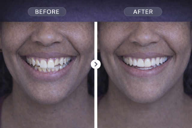 Smile Transformation