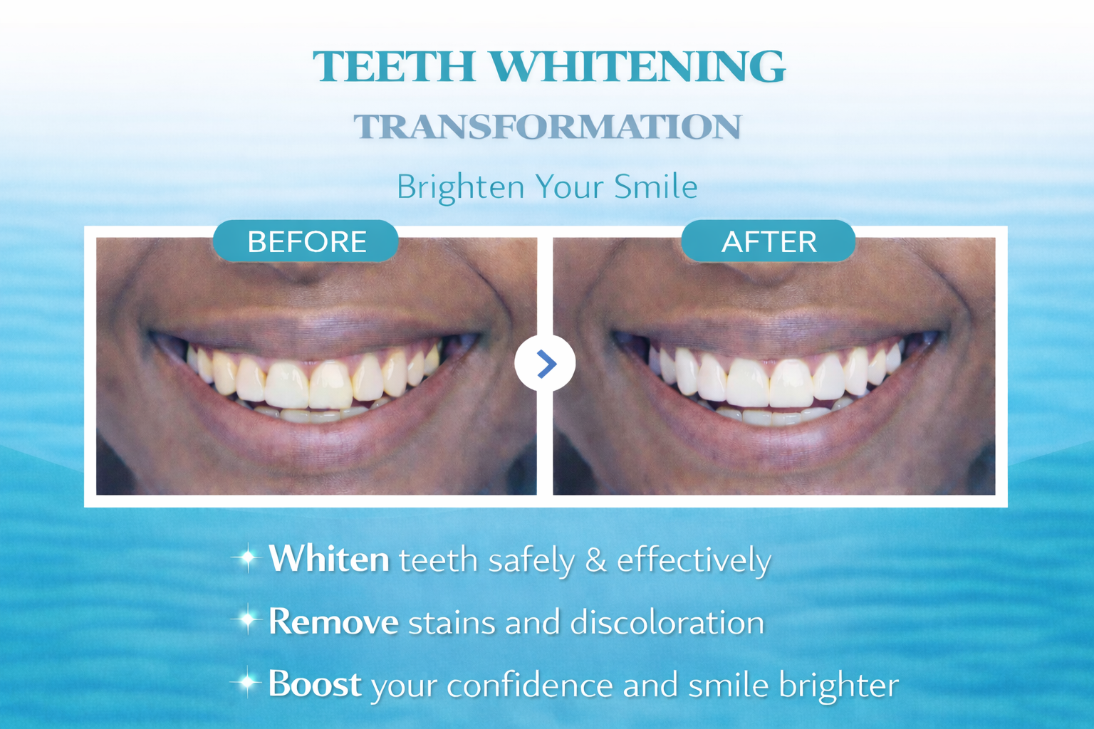 Teeth Whitening